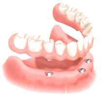 dental implants in mexico