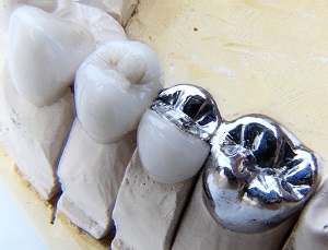 Dental implants in downtown SF