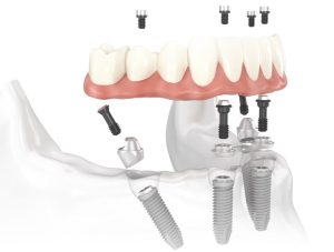 Dental implants may be covered by insurance