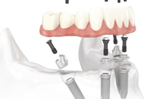 Oakland is a great city in which to live. It’s got great coffee, great music, and great weather. But if you want great dental implants, come across the Bay to SF.