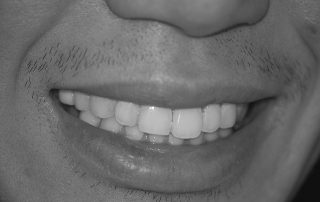 For dental implants, get a second opinion.