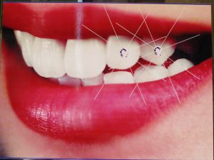 Financing for San Francisco dental implants