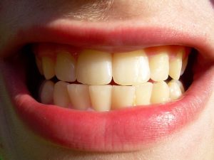 affordable dental implants in San Francisco