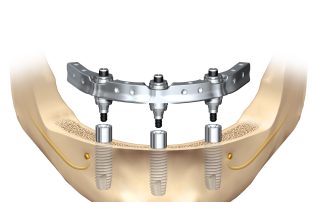 7 good reasons to choose dental implants.