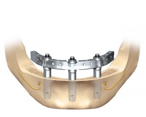 UCSF Dental Implants