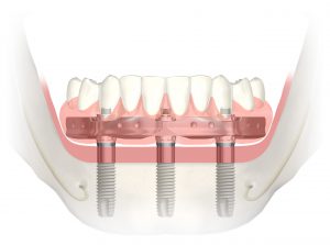 San Francisco dental implants.