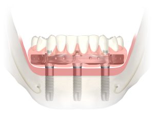 Marin County residents seeking dental implants go to San Francisco.