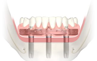 dental implants San Francisco