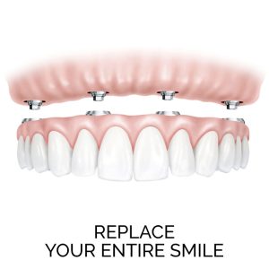 Replace your entire smile - explore how dental implants can improve one's teeth