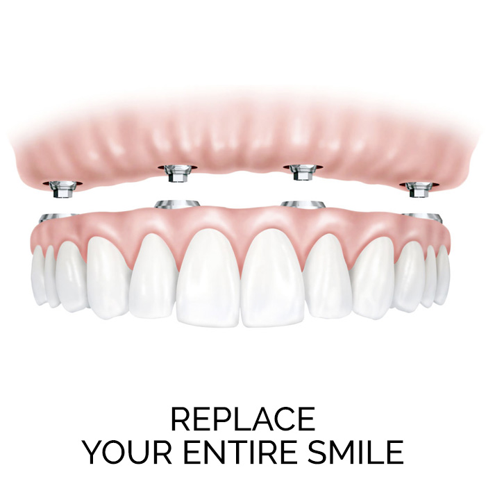 Replace Your Entire Smile