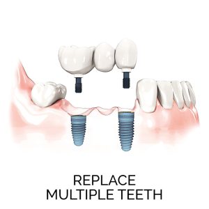 Replace multiple teeth - explore teeth in a day, and full mouth dental implants