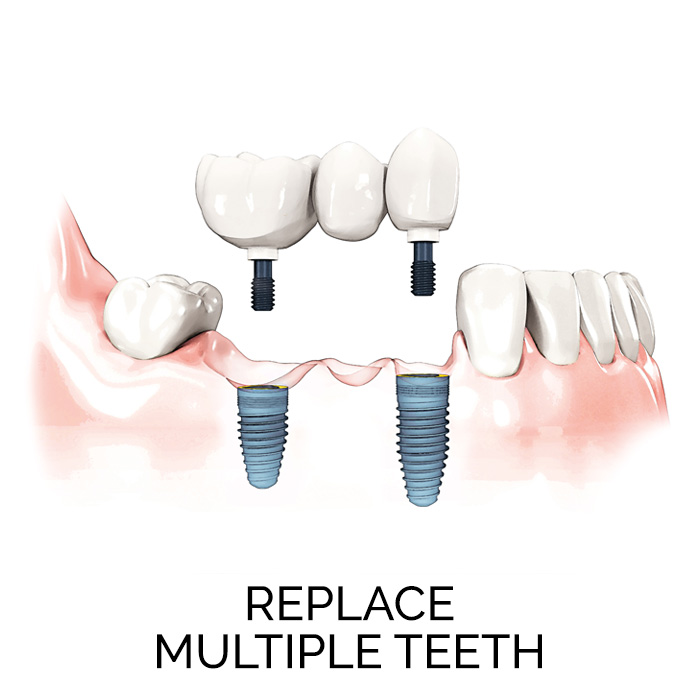 Replace Multiple Teeth