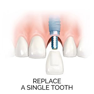 Replace a single tooth - explore top-quality dental implants even for just one tooth