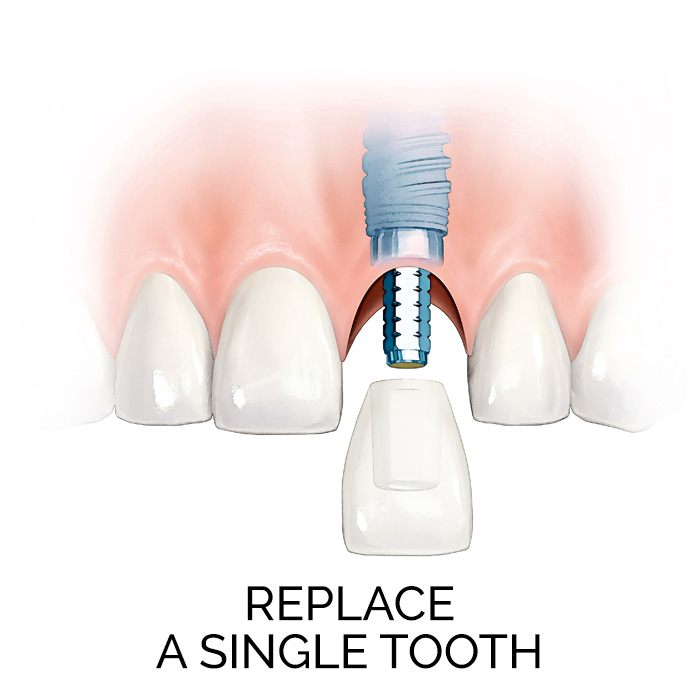 Replace a Single Tooth