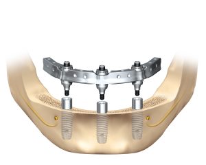 A dental implant center that provides the full range of oral surgery.