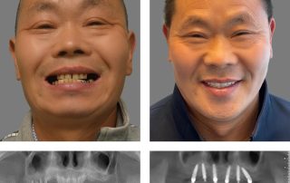 Replace Entire Smile, Full Arch Before and After 1, Alex Rabinovich at San Francisco Dental Implants