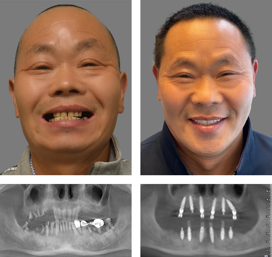Replace Entire Smile, Full Arch Before and After 1, Alex Rabinovich at San Francisco Dental Implants