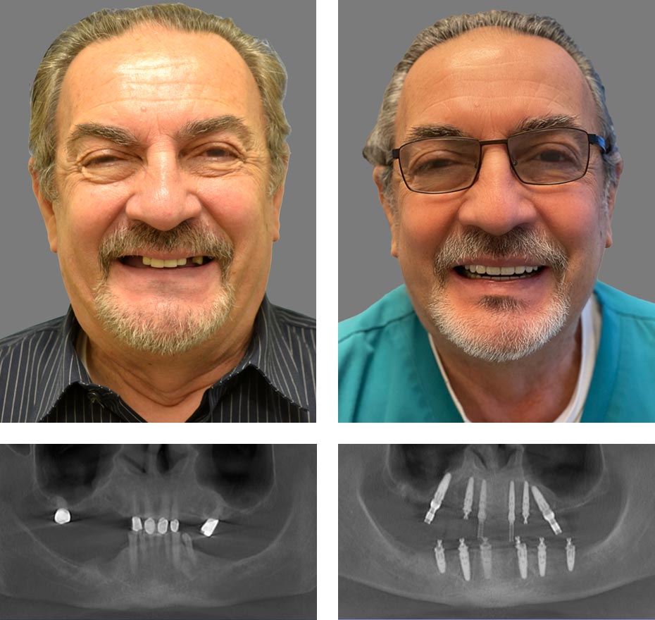 Replace Entire Smile, Full Arch Before and After 10, Alex Rabinovich at San Francisco Dental Implants