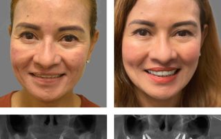 Replace Entire Smile, Full Arch Before and After 11, Alex Rabinovich at San Francisco Dental Implants