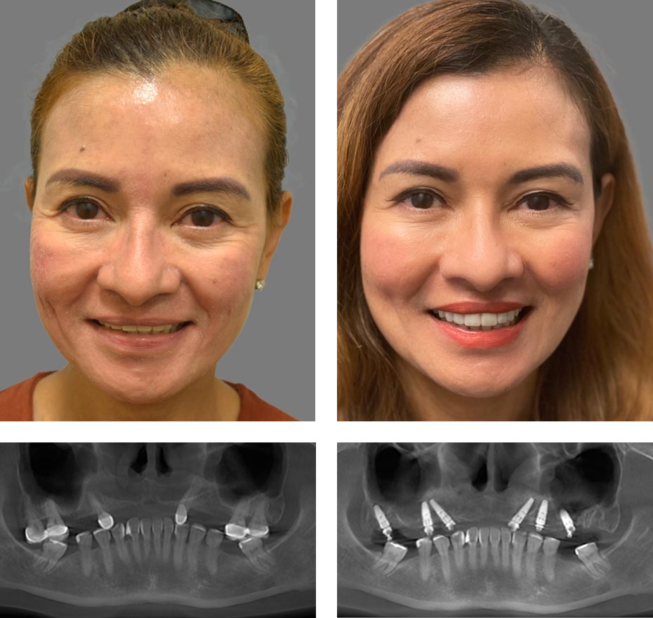 Replace Entire Smile, Full Arch Before and After 11, Alex Rabinovich at San Francisco Dental Implants