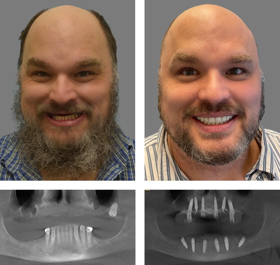 Replace Entire Smile, Full Arch Before and After 12, Alex Rabinovich at San Francisco Dental Implants