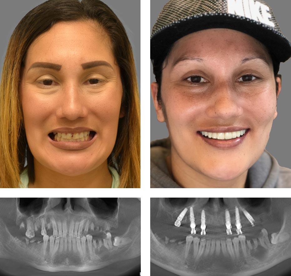 Replace Entire Smile, Full Arch Before and After 13, Alex Rabinovich at San Francisco Dental Implants