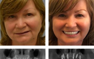 Replace Entire Smile, Full Arch Before and After 14, Alex Rabinovich at San Francisco Dental Implants