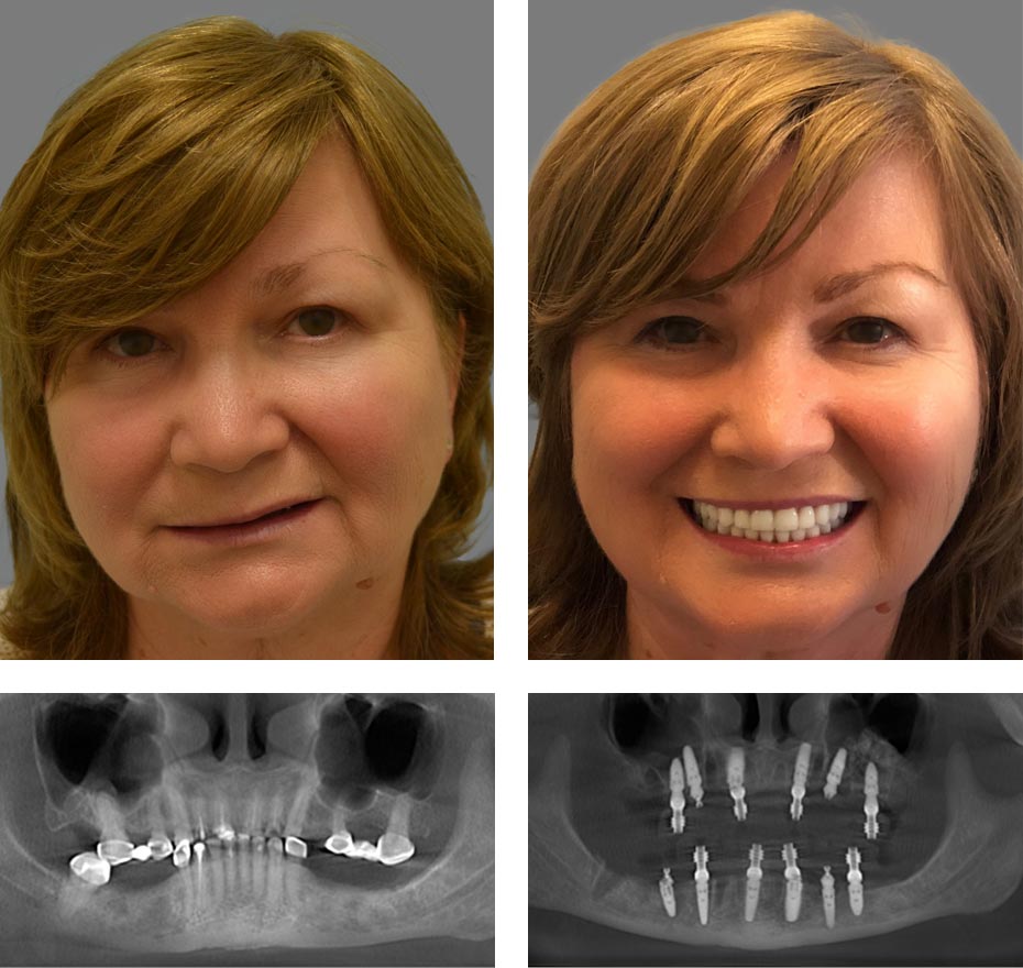 Replace Entire Smile, Full Arch Before and After 14, Alex Rabinovich at San Francisco Dental Implants