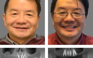 Replace Entire Smile, Full Arch Before and After 15, Alex Rabinovich at San Francisco Dental Implants