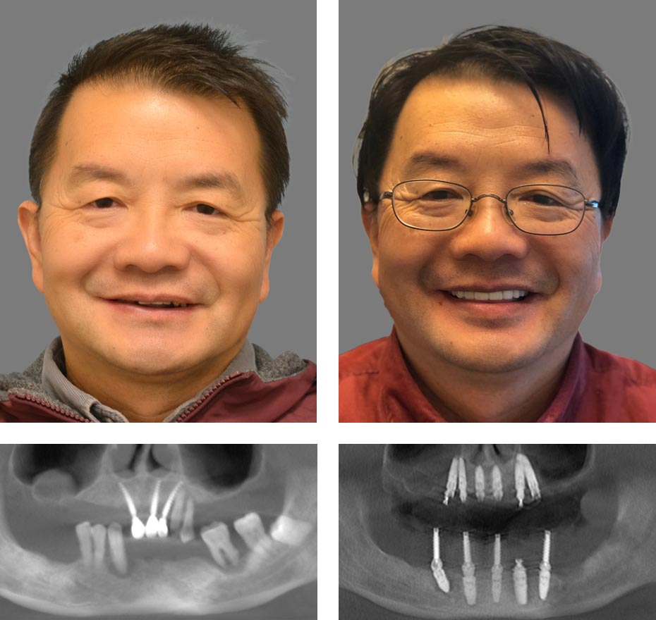 Replace Entire Smile, Full Arch Before and After 15, Alex Rabinovich at San Francisco Dental Implants