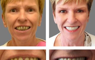 Replace Entire Smile, Full Arch Before and After 16, Alex Rabinovich at San Francisco Dental Implants