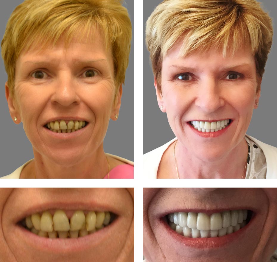 Replace Entire Smile, Full Arch Before and After 16, Alex Rabinovich at San Francisco Dental Implants