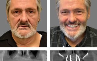 Replace Entire Smile, Full Arch Before and After 2, Alex Rabinovich at San Francisco Dental Implants