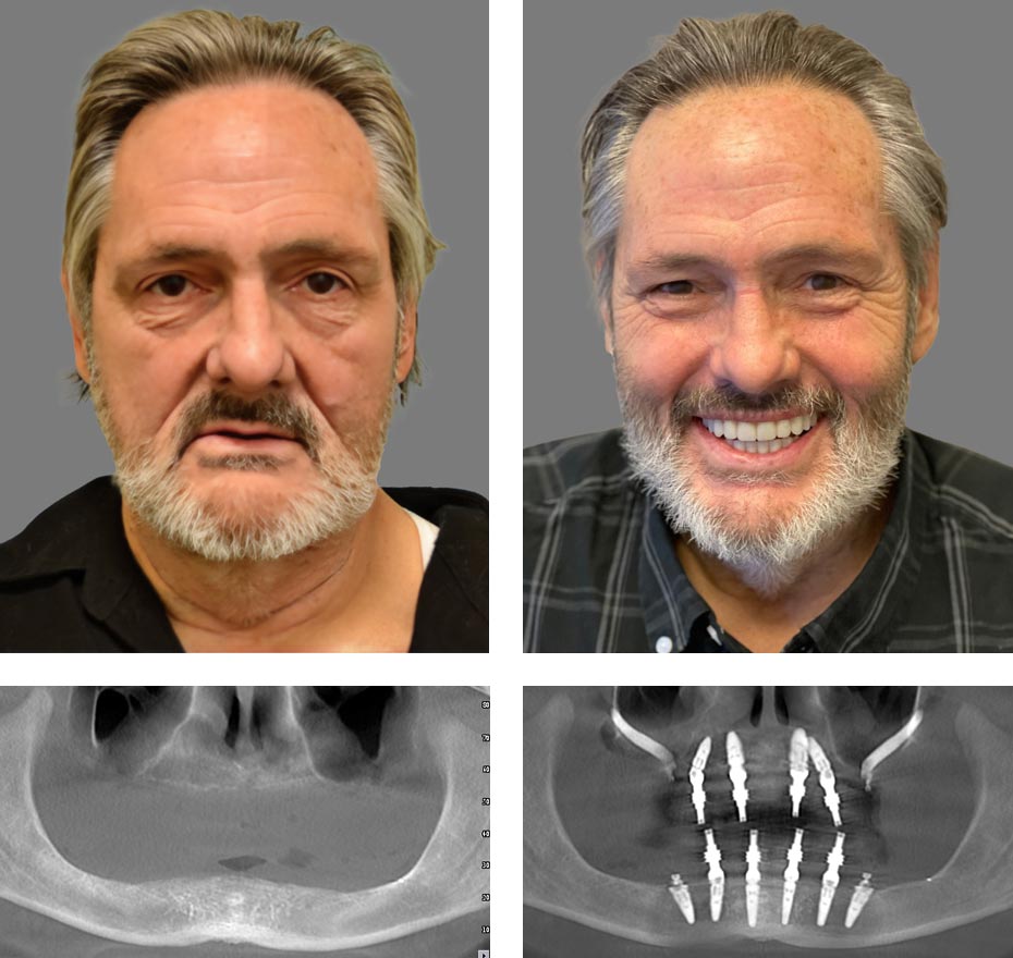 Replace Entire Smile, Full Arch Before and After 2, Alex Rabinovich at San Francisco Dental Implants