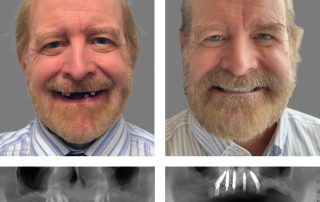 Replace Entire Smile, Full Arch Before and After 3, Alex Rabinovich at San Francisco Dental Implants