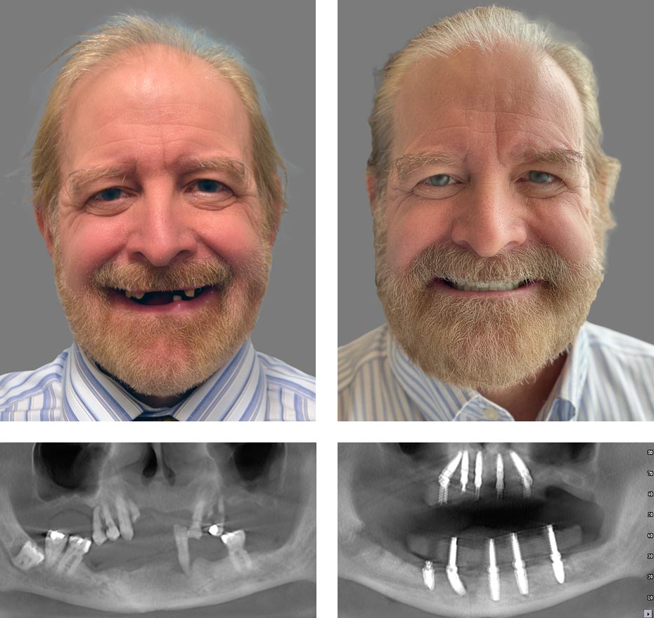 Replace Entire Smile, Full Arch Before and After 3, Alex Rabinovich at San Francisco Dental Implants