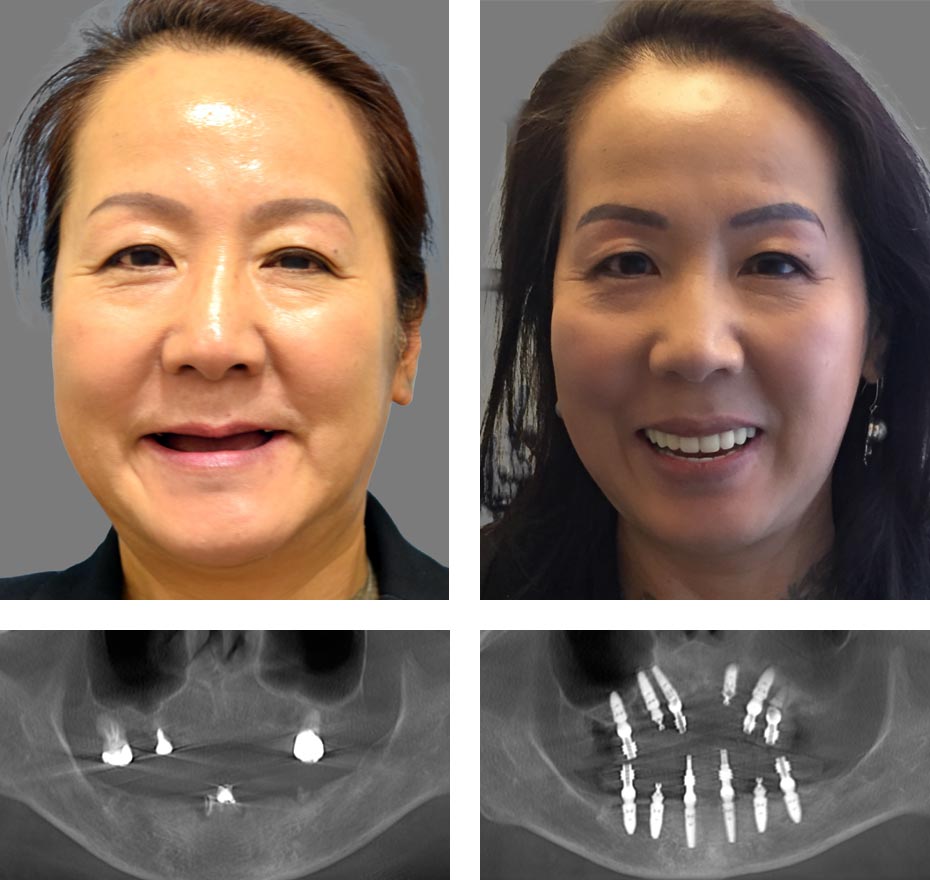 Replace Entire Smile, Full Arch Before and After 5, Alex Rabinovich at San Francisco Dental Implants