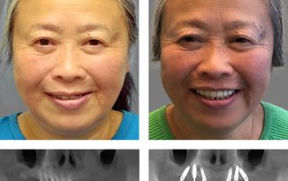 Replace Entire Smile, Full Arch Before and After 6, Alex Rabinovich at San Francisco Dental Implants