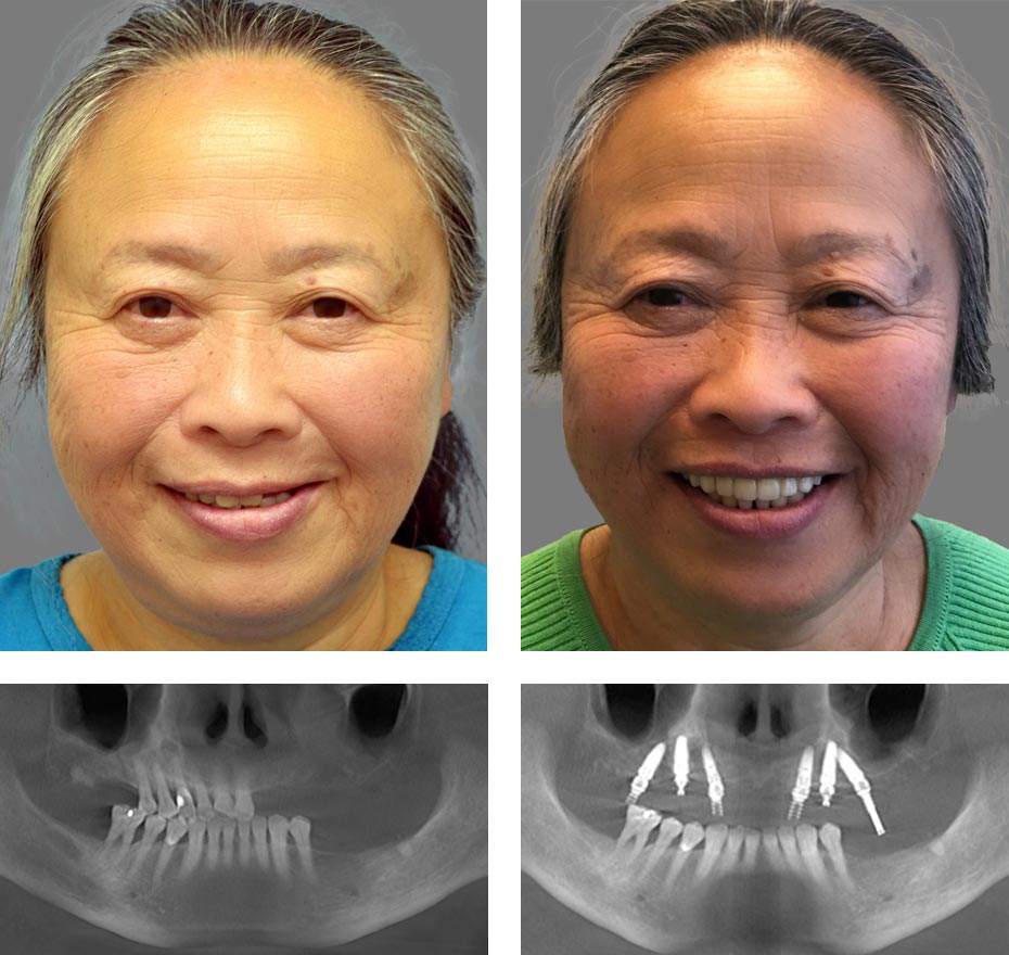 Replace Entire Smile, Full Arch Before and After 6, Alex Rabinovich at San Francisco Dental Implants