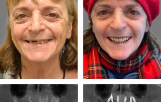 Replace Entire Smile, Full Arch Before and After 7, Alex Rabinovich at San Francisco Dental Implants