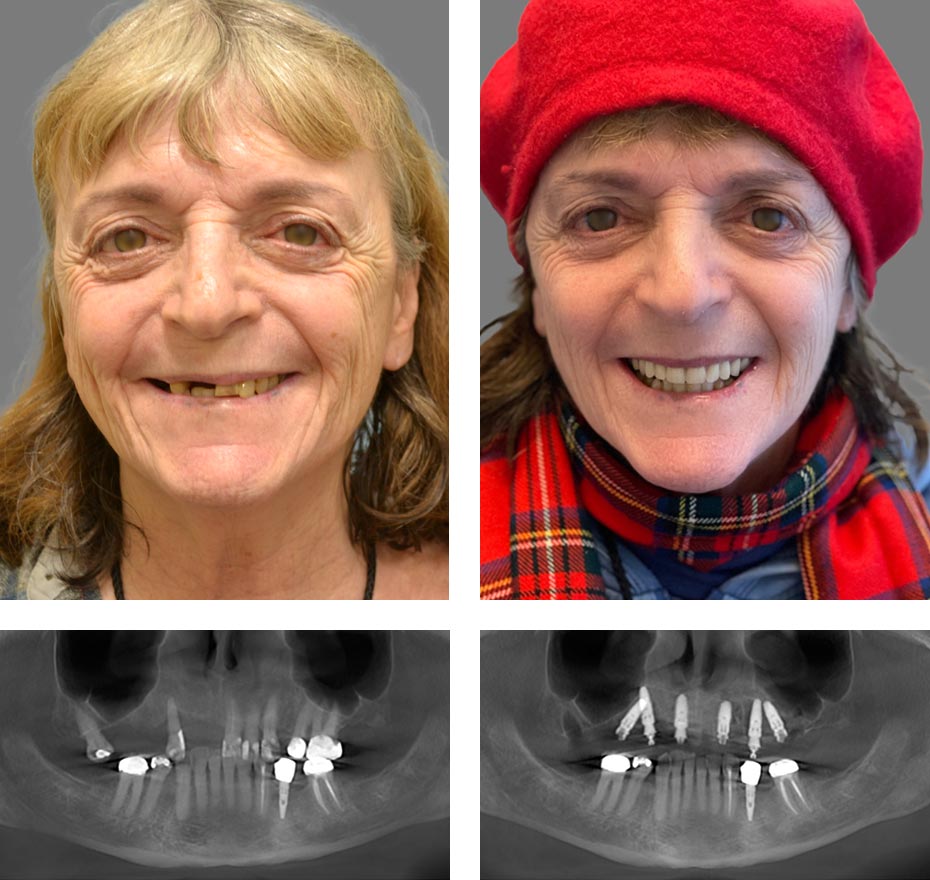 Replace Entire Smile, Full Arch Before and After 7, Alex Rabinovich at San Francisco Dental Implants