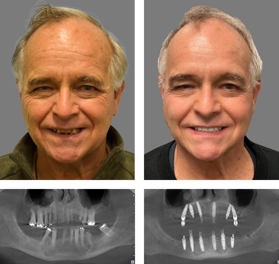 Replace Entire Smile, Full Arch Before and After 8, Alex Rabinovich at San Francisco Dental Implants
