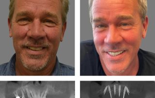 Replace Entire Smile, Full Arch Before and After 9, Alex Rabinovich at San Francisco Dental Implants