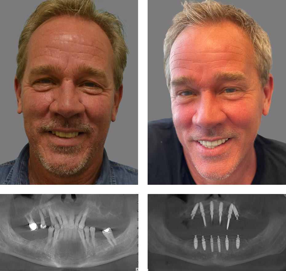 Replace Entire Smile, Full Arch Before and After 9, Alex Rabinovich at San Francisco Dental Implants