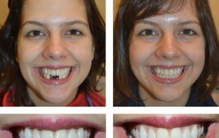 Replace Single Tooth, Implant Bridges Before and After 3, Alex Rabinovich at San Francisco Dental Implants