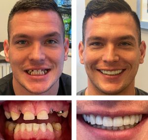 Replace Single Tooth, Implant Bridges Before and After 4, Alex Rabinovich at San Francisco Dental Implants