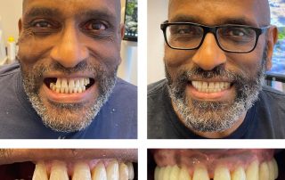 Replace Multiple Teeth, Implant Bridges Before and After 1, Alex Rabinovich at San Francisco Dental Implants