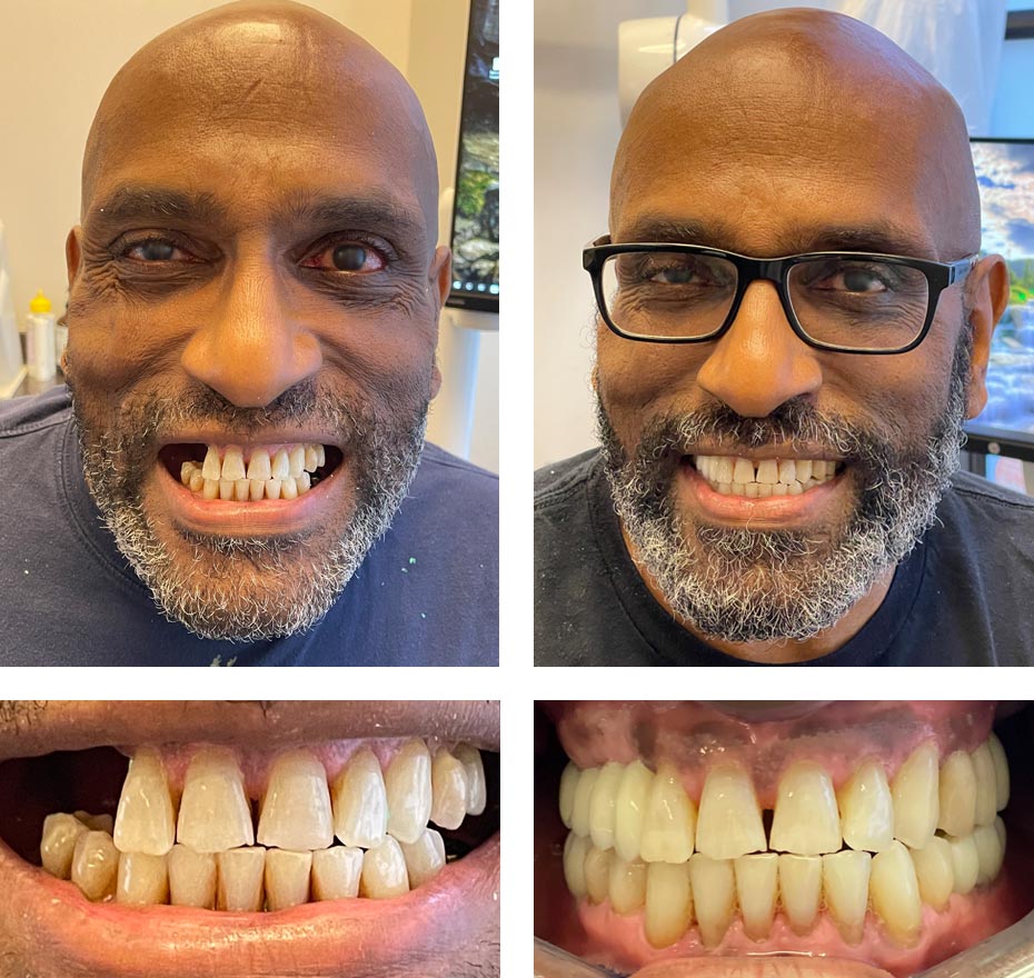 Replace Multiple Teeth, Implant Bridges Before and After 1, Alex Rabinovich at San Francisco Dental Implants