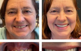 Replace Multiple Teeth, Implant Bridges Before and After 2, Alex Rabinovich at San Francisco Dental Implants