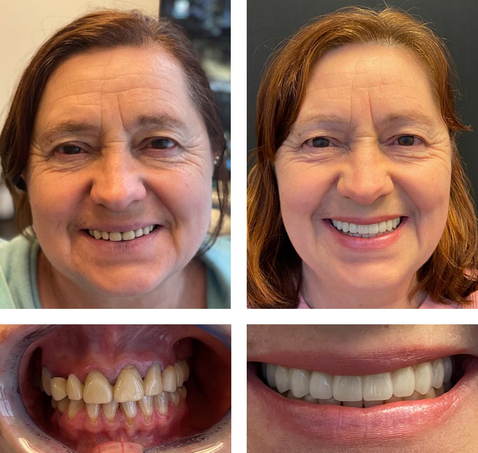 Replace Multiple Teeth, Implant Bridges Before and After, Alex Rabinovich at San Francisco Dental Implants
